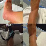 Alexis Sanchez khoe chân lành sau bốn ngày bị bầm dập